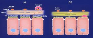 Schematic model of early pathogenic events in CF airways