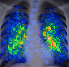 Lung X-ray Image