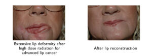 Lip reconstruction before and after at the UNC Center for Facial Aesthetics 
