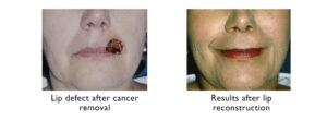 Results after lip reconstruction at the UNC Center for Facial Aesthetics 