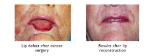 Results of lip reconstruction after cancer surgery - UNC Center for Facial Aesthetics 