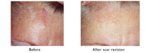 Scar revision before and after - UNC Center for Facial Aesthetics