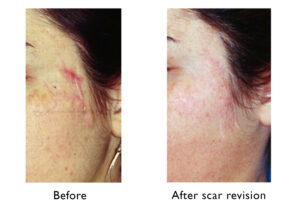 Before and after scar revision 