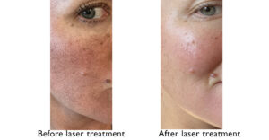 Before and after laser treatment - UNC Center for Facial Aesthetics 