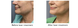 Laser Treatment before and after - UNC Center for Facial Aesthetics 