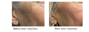 Laser Treatment before and after - UNC Center for Facial Aesthetics 