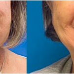 UNC Facial Nerve Center Patient before and after