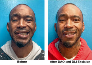 Patient before and after DAO and DLI Excision