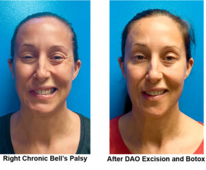 Patient before and after DAO Excision and Botox
