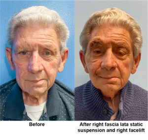 Before and after right fascia lata static suspension and right facelift