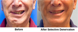 Before and after selective denervation