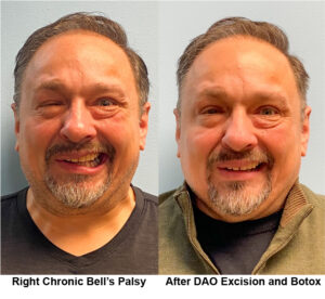 Before and after DAO Excision and Botox