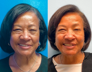 DAO Excision Patient Before and After - UNC Facial Nerve Center