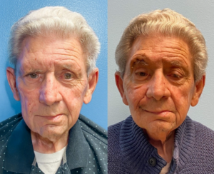 Facial paralysis patient before and after - UNC Facial Nerve Center