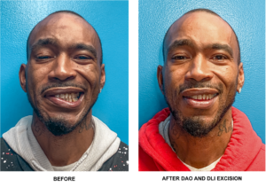 Patient with facial paralysis before and after