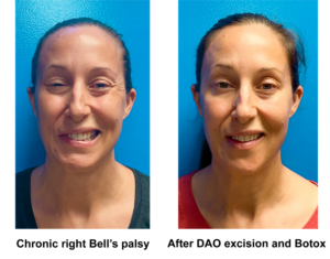 Bell's Palsy Patient before and after treatment at the UNC Facial Nerve Center