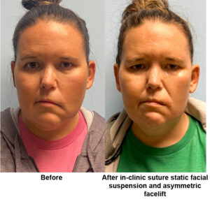 After in-clinic suture static facial suspension and asymmetric facelift