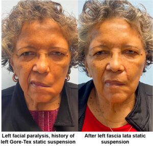 Patient before and after fascia lata static suspension