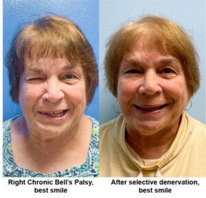 Bell's Palsy Patient before and after - UNC Facial Nerve Center