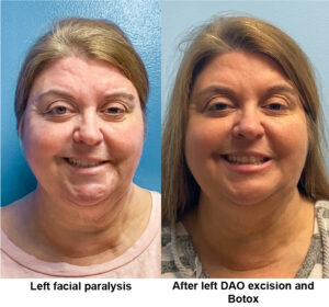 Patient before and after DAO excision and Botox
