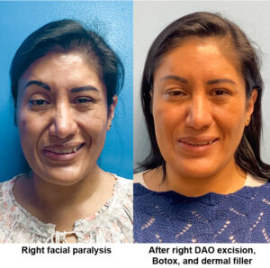 Patient before and after DAO Excision, Botox, and dermal filler