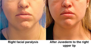 Before and after Juvederm to the right upper lip