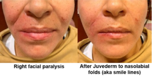 Before and after Juvederm to nasolabial folds 