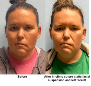 UNC Facial Nerve Center patient before and after facelift