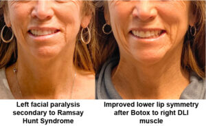 Before and after - Improved Lower Lip Symmetry after Botox to right DLI Muscle