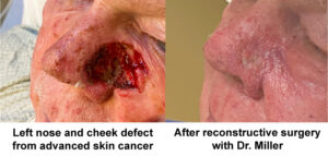 Before and after patient, cheek defect from skin cancer