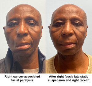 Patient before and after right fascia lata static suspension and right facelift