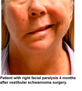 Patient with right facial paralysis