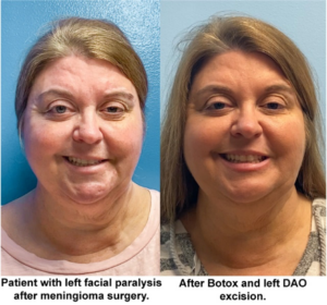 Patient before and after DAO Excision