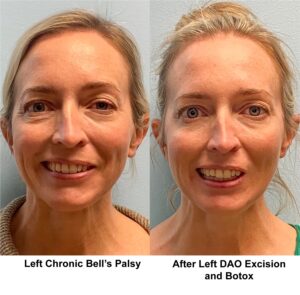 Before and After DAO Excision and botox