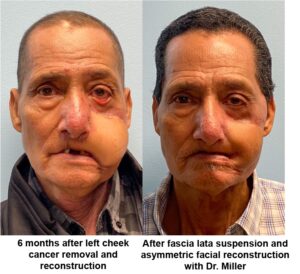 Before and After cancer removal reconstruction