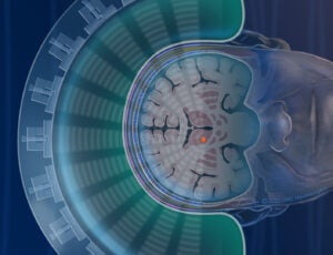 Focused ultrasound at UNC Health