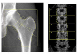 DEXA scans can be used to determine bone mineral density.
