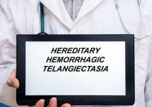 Hereditary hemorrhagic telangiectasia.
