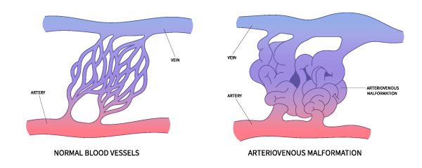 Normal blood vessel vs. on with a arteriovenous malformation.