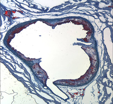 Oil-Red-O stained aortic root atheroma