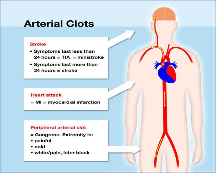Arterial Clot