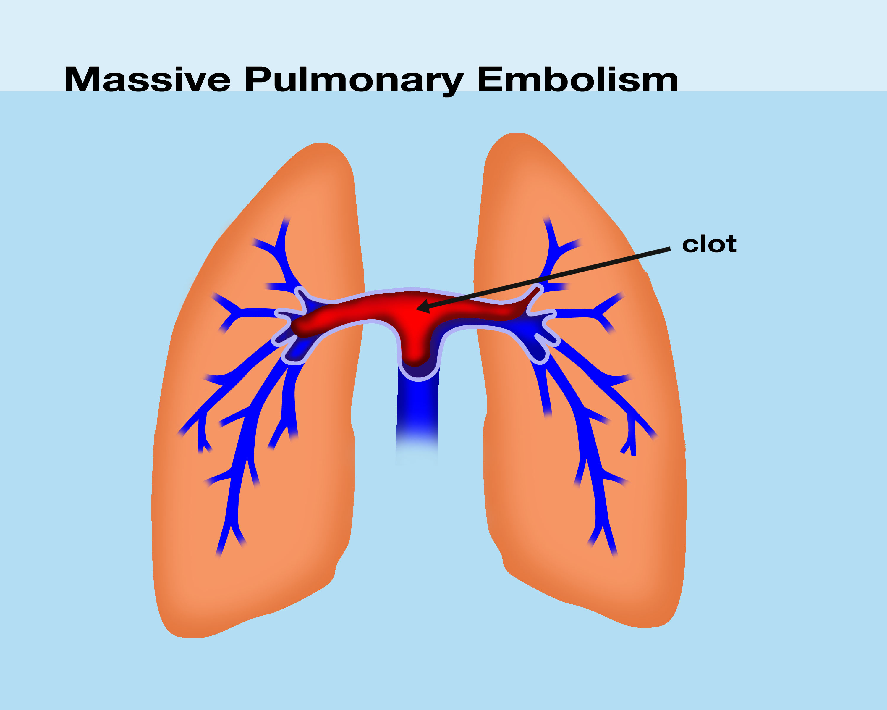 Pulmonary Embolism Massive