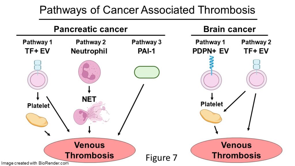 Pathways of cancer associated venous thrombosis. There are three pathways for pancreatic cancer. In the first, tissue factor works through platelets or directly. In the second, neutrophils release NETs. In the third, PAI-1 acts directly. There are two pathways for brain cancer. In the first, PDPN positive EVs work through platelets. In the second, tissue factor works through platelets or directly.
