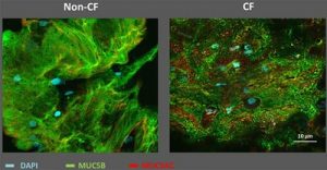 Fig 1. Immunolabeling of mucins and DNA in pediatric bronchoalveolar lavages. Confocal images revealing different mucin network topologies between CF and non-CF patients. (Blue=DAPI, Green=MUC5B, Red=MUC5AC).