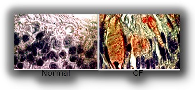 Figure 5. IRE1β expression is up-regulated in mucous cells from native inflamed CF human bronchial epithelia. IRE1β immunostain in normal and CF human bronchial epithelia. From Martino et al (2012): The ER Stress Transducer IRE1β is Required for Airway Epithelial Mucin Production. Mucosal Immunol. Nov 21. doi: 10.1038/mi.2012.105. [Epub ahead of print].