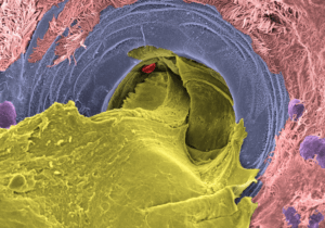 Magnified image showing the inside of a mucus-producing gland in the airway of a person with cystic fibrosis