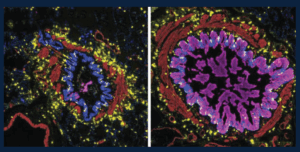 Magnified image of mucus plugs in asthmatic bronchioles