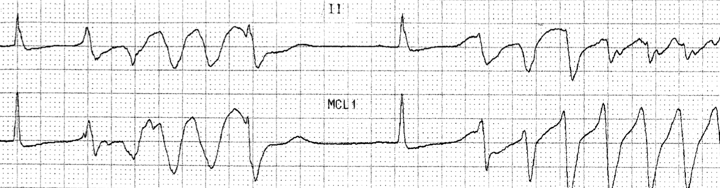 EKG showing Long QT