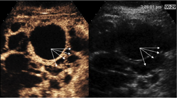 CEUS image from a patient with polycystic kidney disease. Conventional grayscale images are on the right; single time point contrast-enhanced images are on the left. (Urology 2016; 87:1-10)
