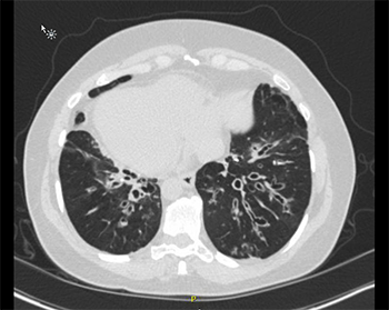 bronchiectasis in both lungs
